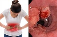Đi khám vì đau bụng, thiếu nữ 16 tuổi phát hiện ung thư dạ dày di căn